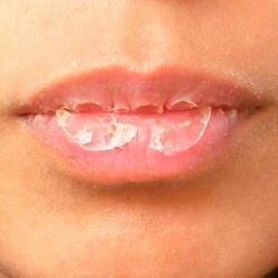 buzele crăpate și pierderea în greutate ped uri pediatrice laboratoare