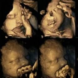 Fotos УЗИ показывают, как ребенок в утробе реагирует на курение матери