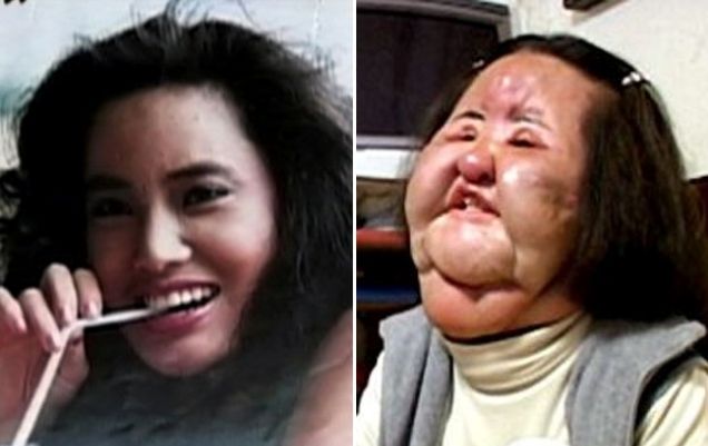 Schockierende Opfer der plastischen Chirurgie