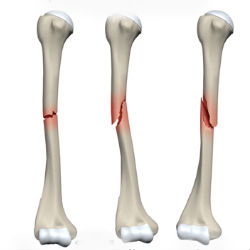 Typy переломов костей